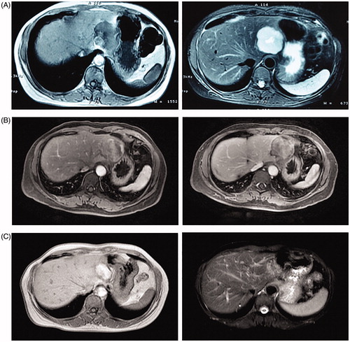 Figure 4. An MRI of one patient (n = 1 hemangioma, 6.3 cm in diameter) pre-MWA, one month post-MWA, and 12 months post-MWA. (A) Pre-MWA. (B) One month post-MWA. (C) 12 months post-MWA.
