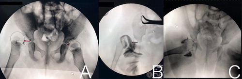 Figure 2. A. L distance (red arrow). The distance between the iliac bone and the surface of the cartilaginous femoral head (b) on a line drawn from the inferior end of the ilium (c) to the center of the cartilaginous femoral head (a). B. Arthrogram of a dislocated hip with elongated L distance. C. Arthrogram of a hip with an acceptable reduction.
