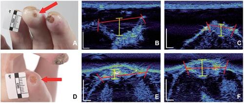Figure 3 Digital ulcer ultrasound. Fingertip DU (A) and extensor aspect (D) (with the DU indicated by a red arrow). DU using high-frequency ultrasound images of the “long” (B) and “short” axis. Measurements (B and C and E and F) can be obtained of the ulcer width (red bars) and depth (yellow bars).