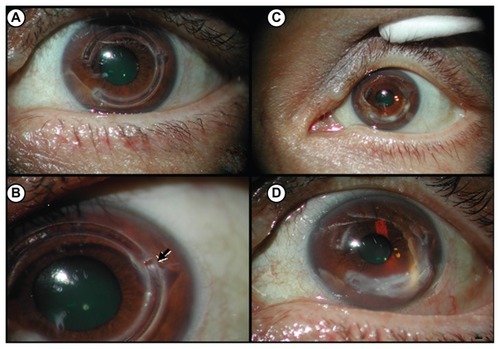 Figure 1 Slit-lamp photographs of left eye following intrastromal corneal ring segments (Intacs®) insertion. (A) Four months after Intacs insertion. (B) Spontaneous extrusion of inferior Intacs ring implant (arrow) 5 months following original insertion and prior to ring replacement. (C) Initial stromal infiltrates observed 8 months post Intacs insertion (3 months post replacement). (D) Stromal infiltrates at 10 months after initial Intacs insertion and prior to therapeutic keratoplasty.