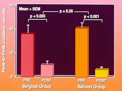 Figure 8 Bar graph shows comparison of pressure gradient reduction immediately after surgical and balloon therapy. Note significant reduction in peak-to-peak pressure gradient in both the surgical (p < 0.005) and balloon (p < 0.001) groups. This fall in pressure gradients in both groups is not significantly different (p = 0.28) form each other. Mean + standard error of mean (SEM) are shown. PRE, prior to; POST, following. Modified from Rao PS, Chopra PS, Koscik R, Smith PA, Wilson AD. Surgical versus balloon therapy for aortic coarctation in infants ≤3 months old. J Am Coll Cardiol. 1994;23(6):1479–1483.Citation42 doi: 10.1016/0735-1097(94)90395–6.