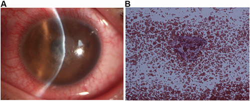 Figure 3 A 26-year-old man with a 1.5-mm  melt in the central anterior corneal cap with diffuse dense infiltration at the corneal cap–stromal bed interface, and multiple keratic precipitates in the left eye 3 days after SMILE (A). Smear examination shows Gram-positive cocci (B).