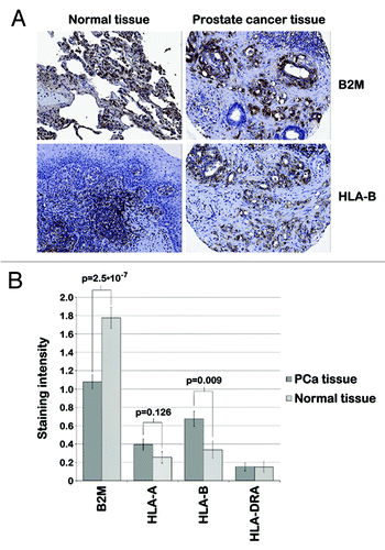Figure 2. IHC staining of human prostate tissue. A TMA performed with PCa tissue and normal surrounding tissue from 71 patients with primary PCa indicated deregulated MHC protein expression in human PCa tissue (p < 0.001). (A) Representative images of human PCa and normal prostate tissue stained for B2M (top) and HLA-B (bottom) via immunohistochemistry show decreased expression of B2M and increased expression of HLA-B in PCa tissue compared with normal surrounding tissue in a PCa patient. (B) B2M, HLA-A, HLA-B and HLA-DRA protein expression was scored by measuring the staining intensity of these proteins in immunohistochemistry samples from 71 PCa patients by two investigators independently (0, no staining; 1, light staining; 2, medium staining; 3, strong staining). The mean staining intensity of 71 cancerous and non-cancerous tissue samples is displayed in the bar graph. B2M and HLA-B protein expression was significantly different between PCa and normal surrounding tissue (p = 2.5·10−7 and p = 0.009, respectively), while there was no eminent change in HLA-A and -DRA protein expression (p > 0.05).