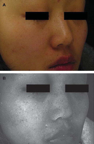 Figure 1. The ABNOM lesions in the first patient on the lower eyelids, nose, and malar regions taken under (A) standard light and (B) ultraviolet light.