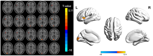 Figure 3 Differential brain regions of ALFF in the slow-5 band between the AP and HC groups.