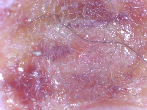 Figure 1 Embedded cutaneous blue and white filaments.