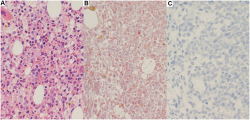 Figure 2 Bone marrow biopsy. (A–C) A small number of naive plasma cells were present away from the trabecular bone (no significant atypia), along with local fibrous hyperplasia with plasma cell hyperplasia (approximately 20%). (A) HE, ×400. (B) Masson staining (mild fibrous hyperplasia), ×400. (C) MPO (+), ×200.