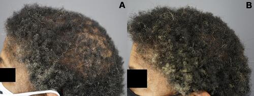Figure 6 Left parietal area and vertex of patient 3 Images of the left parietal area and vertex of a patient diagnosed with central centrifugal cicatricial alopecia obtained 13 months after micronized fat injection, oral minoxidil, topical Gashee applications (once daily), and oral Gashee supplements (A). Images of the same area 3 months after treatment changed to topical Gashee treatments (twice daily) and oral minoxidil are shown (B).