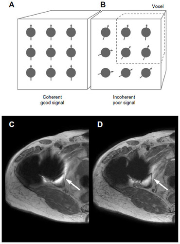 Figure 4 Diagram representing a voxel in which all the protons have the same phase of spin and are considered to be coherent (A), which results in good signal. In the presence of metal, a steep susceptibility field gradient will spread the phases across a voxel (B). The greater the spread of phases, the less coherence between protons there is and the worse the signal. The spread of phases within a voxel can be reduced by reducing the size of the voxel. The proton spin is more coherent, but there are fewer protons to contribute to the signal, which increases noise. Reducing voxel size can be achieved by increasing the matrix or, as in this case, reducing slice thickness. A 6 mm thick slice axial T2 weighted magnetic resonance slice through a right total hip replacement (C) is reduced to a 3 mm thick slice (D) with all other parameters remaining fixed. There is increased conspicuity of the right ischial tuberosity (white arrows) on the thinner slice, but a visible increase in noise.