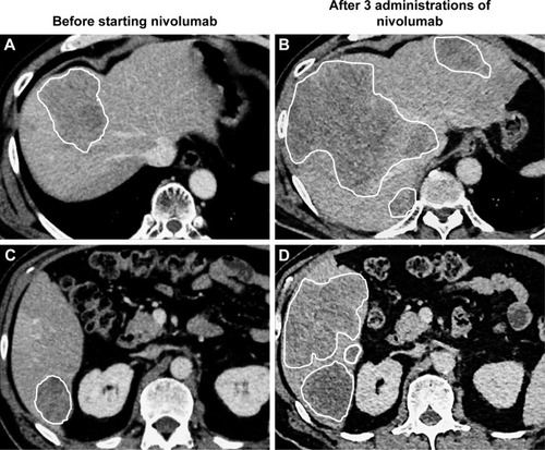 Figure 2 CT imaging of hyper-progression.