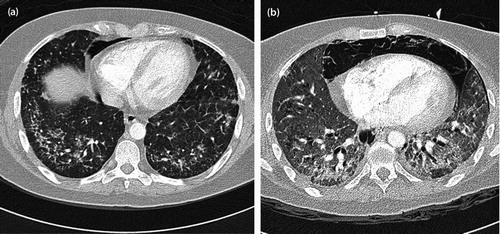 Figure 2: (a) Initial and (b) follow-up CT scan: upper lungs axial CT slices (lung windows): (a) There is intra- and inter-lobular septal thickening with associated ground-glass opacification and an incidental small-volume pneumomediastinum, the aetiology of which is not clear, possibly related to an air leak from the adjacent lung pathology. The lung changes are consistent with an NSIP pattern of lung injury or an organising pneumonia. (b) Interval progression is noted in terms of severity as well as area of the lung involved. There is now diffuse ground-glass opacification of the lungs as well as established fibrosis with regions of honeycombing. The large ground-glass component suggests an active cellular component to the disease and the radiological picture favours a mixed cellular fibrotic NSIP pattern of lung injury. The pneumomediastinum progressed and there is a left-sided pneumothorax.