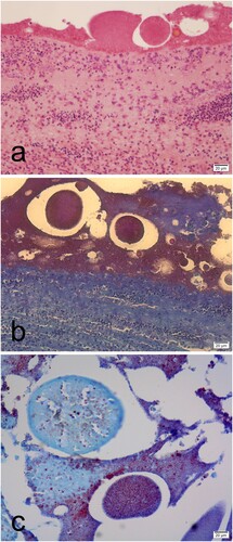 Figure 5. Histological sections of the embryo showing granular deposits around the integument embryo that stain eosinophilic with haematoxylin & eosin (a) and granular dark red with Gram Twort (b, c). Granular deposits with macrophage infiltrations were observed in the integument (a). Detail of the integument showed a feather surrounded by granular deposits stained dark red with Gram Twort (c).