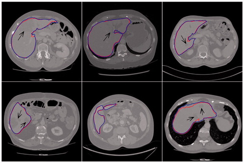 Figure 4. Liver segmentation results of our proposed method.