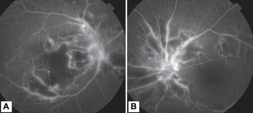 Figure 2 Fundus fluorescein angiography of a 44-year-old male presenting with diminution of vision following dengue fever. (A) Right eye. (B) Left eye. Both eye showing disc and perivascular leakage limited to posterior pole indicative of vasculitis. In addition, there is capillary nonperfusion due to occlusion of multiple small arterioles supplying the macula of right eye confirming macular ischemia.
