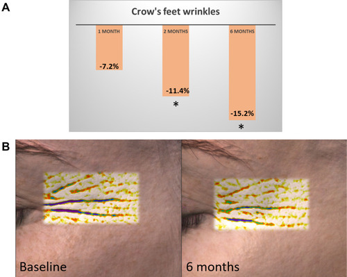Figure 3 Example of anti-wrinkle benefits of multi-step regimen over 6 months. (A) Mean Crow’s feet wrinkle depth percentage reduction on the tested panel using a 4-step skin care regimen, as measured by the Antera 3D. Consistent and incremental efficacy could be observed over a period of 6 months. *Significance vs baseline (Repeated measures ANOVA with Dunnett post-hoc, P<0.05). (B) Representative image of one volunteer crow’s feet area at baseline and following 6 months of using the 4-step skin care regimen. The depression in the skin are depicted in lighter colours at 6 months, showing a reduced depth of the wrinkles.