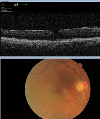 Figure 1 OCT image of lamellar macular hole with epiretinal membrane (top). Bottom shows corresponding color fundus image.