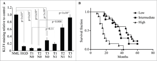 Figure 3. KLF4 expression in ESCC is associated with advanced cancer stage and decreased patient survival. (A) Compared to adjacent normal tissue, KLF4 expression was decreased in high-grade dysplasia and early-stage ESCC but not in more advanced ESCC. Note that for tumors of the same size, KLF4 levels were higher for those with nodal metastases than those without. (B) Kaplan-Meier survival curves demonstrated poorer survival for patients with high levels of KLF4 compared to those with low or intermediate levels (p < 0.0001).