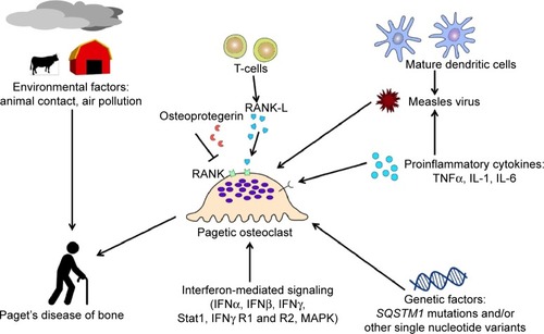 Figure 2 Pathophysiology of Paget’s disease of bone and its relation to osteoimmunological cells and cytokines.