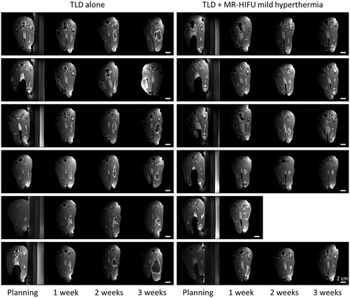 Figure 5. Rabbit Vx2 tumour response after hyperthermia-mediated drug delivery using thermosensitive liposomal doxorubicin and MR-HIFU. Contrast-enhanced T1-weighted images from treatment planning and 1, 2, and 3 weeks post-treatment. Axial images through the 3D volume are shown at the location of the maximal tumour extent. Left: Rabbits treated with TLD alone. Right: TLD plus MR-HIFU mild hyperthermia. Scale bar = 2 cm. TLD, thermosensitive liposomal doxorubicin.