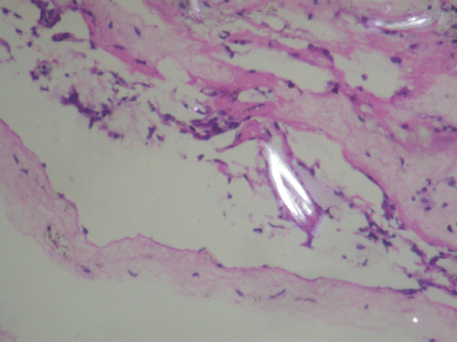 FIGURE 3  Vitreous sample showing a cyst lined by fibrocollagenous tissue. Cyst contains hooklets (arrow). Cyst wall contains lymphocytic infiltration (hematoxylin and eosin [H&E], 200× with polarized light).
