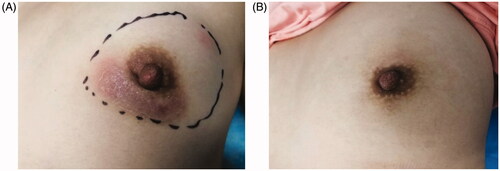 Figure 4. Changes in IGM before and after ablation. (A) Before ablation: the marker indicates palpable lesions and the expected ablation range under ultrasound. (B) At 9 months after ablation: the appearance and texture of the breasts are completely back to normal, with no scars.