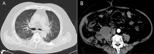 Figure 1 (A) Pulmonary CT showed bilateral pneumonia; (B) Abdominal CT indicated irregular nodular or slightly low-density shadows with multiple soft tissue densities in the right renal hilum, right retroperitoneal space, and right pelvic extraperitoneal space, with the largest of those locating in front of the right iliac muscle (white Arrow), measuring about 52mm × 38mm, suggesting infectious lesions and encapsulated effusion.