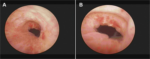 Figure 3 The anastomotic area of the patient 3 months after surgery under cystoscopy. The two images (A, B) show that there was no anastomotic stricture or neoplasm in the anastomotic area, and the mucosa of the anastomotic area was smooth and flat.