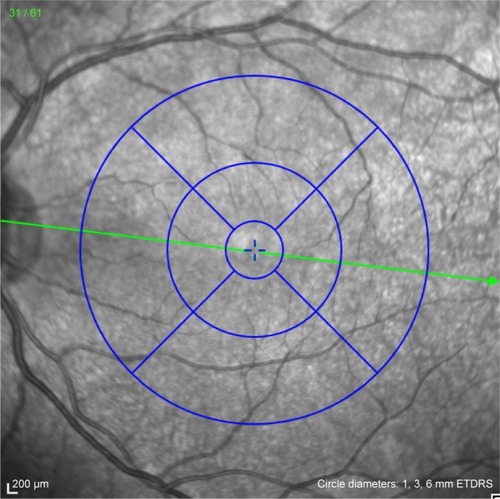 Figure 1 The ETDRS sectors at the posterior pole. The center circle is 1 mm, the inner circle is 1–3 mm and the outer circle is 3–6 mm.
