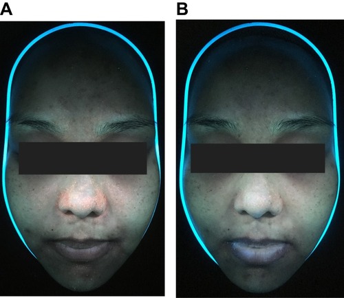 Figure 3 Fluorescence photographs (A) before and (B) after the treatment. In this patient, the right side of the face was treated with PDT with RT gel and the other side was treated with PDT with ALA.