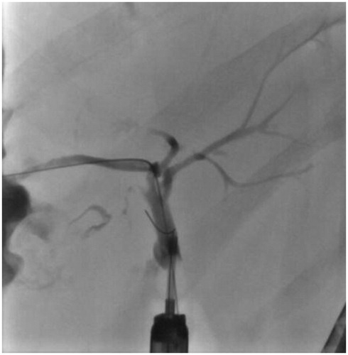 Figure 10. The fluoroscopy view of patient (number 7) with right site intrahepatic stricture before stenting.