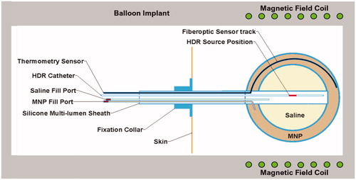 Figure 1. Thermobrachytherapy balloon design. The outer balloon is filled with MNP to heat tumor bed and the inner balloon is inflated with saline to expand the resection cavity wall into more advantageous near-spherical geometry. A catheter extends through the flexible shaft and along the outer balloon wall to insert a temperature monitoring and control sensor. A central catheter extends from the surface to the balloon center for inserting an HDR radiation source. Two catheters extend from valved ports to fill the balloons with saline and MNP solution.