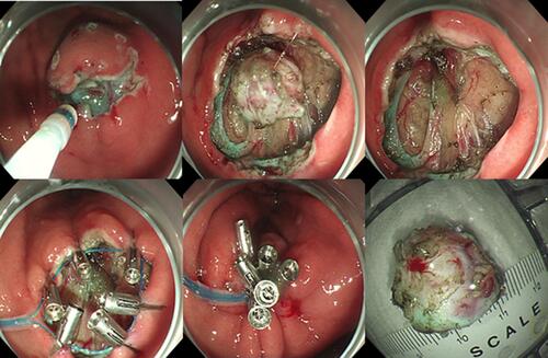 Figure 2 Complete endoscopic full-thickness resection of tumor; clips combined with purse-string suture closure of wounds.