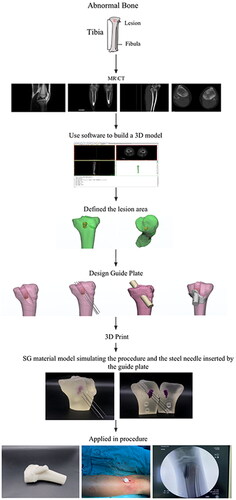 Figure 1. Clinical flowchart of 3D printing navigation system application in pediatric epiphyseal complex lesion surgery.