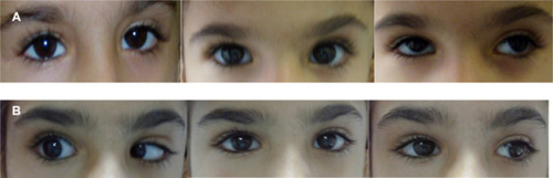 Figure 2 Right type 1 Duane’s syndrome. (A) Preoperative appearance (−2 restriction on abduction, narrowing of the palpebral fissures, globe retraction, and upshoot on attempted adduction of right eye). (B) Postoperative appearance (−1 restriction of right abduction, no globe retraction or upshoot, orthotropic in primary position).