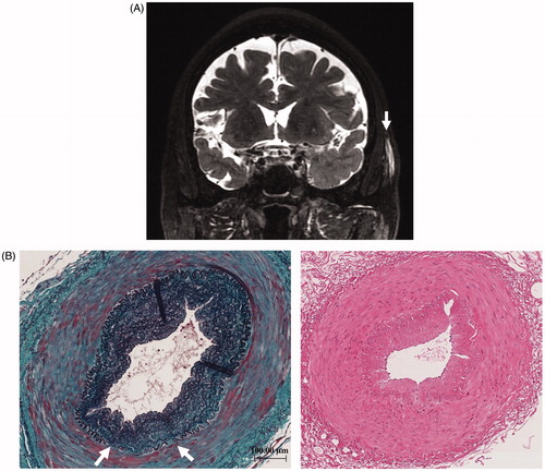 Figure 1. (A) The fat-suppression T1-weighted MRI showing subcutaneous thickening and partial vascular flow void signal that correspond with left temporal artery; arrow. (B) Left temporal artery biopsy (TAB) revealed the intimal fibrous thickening, small rupture and fibrotic change of internal elastic lamina (left panel; Elastica-Masson staining, white arrows). No apparent inflammatory cell infiltration or giant cell (right panel; Hematoxylin and Eosin staining).