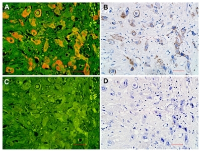 Figure 1 EGFR expression on breast cancer cells by quantum dot-immunohistochemistry and immunohistochemistry. EGFR-positive expression on breast cancer cells imaged under Olympus DP72 camera (400×) by quantum dot-immunohistochemistry (A) and immunohistochemistry (B), control group (rabbit IgG) showed no any positive expression on breast cancer cells by quantum dot-immunohistochemistry (C), and immunohistochemistry (D). Scale bar: 25 μm for (A, B, C, and D).Abbreviation: EGFR, epidermal growth factor receptor.