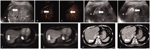 Figure 3. A 51-year-old female patient with four CRLM. (A) After artificial hydrothorax injection of 600 ml of saline (*), percutaneous US clearly showed one lesion 11 mm in diameter (thick arrow) under the diaphragm. (B) CEUS showed the lesion (thick arrow) with homogeneous hyper-enhancement in the arterial phase (30 s). (C) The lesion (thick arrow) presented hypo-enhancement in the late phase (180 s). (D) The antenna (thin arrow) was inserted into the lesion 5 mm beyond the deep margin of the lesion (thick arrow) under US guidance, and then the MWA procedure was initiated (50 W, 10 min). (E) US showed that the lesion (thick arrow) was completely covered by hyperechoic gas during the ablation procedure. (F–G) The ablation zone (thick arrow) showed non-enhancement in the arterial and venous phases of CEMRI 1 month after ablation. (H–I) The ablation zone (thick arrow) was smaller and showed non-enhancement in the arterial and venous phases of CECT 30 months after ablation.