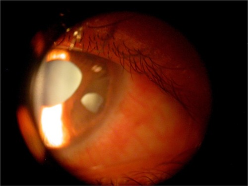 Figure 2 Iris holes and corectopia in OD.