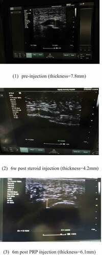 Figure 2. US-guided pre- & post-steroid injection follow up of fascia thickness..