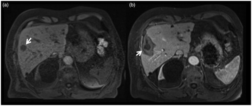 Figure 1. 79-years-old male patient treated for a singular hepatic metastasis of a melanoma. Unenhanced T1-weighted planning imaging (a) depicts the target tumor in segment V (arrow) measuring 18 mm. Contrast-enhanced control imaging in the portal-venous phase shows the ablation zone with the contour of the treated tumor (b). Die smallest safety margin was measured with 5 mm at the lateral portion of the ablation zone (arrow).