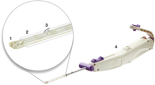 Figure 1. Device used for carpal tunnel release with ultrasound guidance. Key device characteristics include: 1) blunt dissecting rigid polymer tip; 2) two laterally located polymer balloons (inflated in figure); 3) retractable stainless-steel retrograde cutting blade (in active position in figure); 4) handle housing device controls.