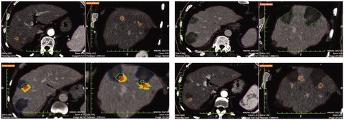 Figure 5. Top left: Pre-ablation segmentation of two HCCs in the same patient. Top right: Post-ablation segmentation of the coagulation volumes achieved. Bottom left: pre- post-ablation registration. Calculations rendered are the following: residual unablated tumor 78.9% and 100% respectively and residual unablated 5 mm margin 77.6% and 93.0% (the inner solid portion outside the necrosis is the unablated tumor and the outer solid portion outside the necrosis is the unablated safety margin). Bottom right: 1-year follow-up CT with LTPs segmentations. LTPs developed in the exact location where residual unablated tumor was shown in the pre-post-ablation registration (bottom left image).