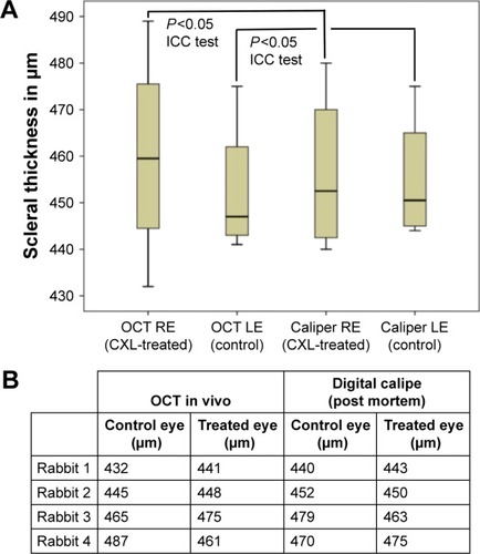 Figure 3 (A) Box plot chart. Scleral thickness measurements in treated and control eye with anterior OCT (in vivo) and with the digital caliper (measurement: postmortem). Statistical analysis performed with ICC test revealed showed a significant result. (B) Table with scleral thickness data.