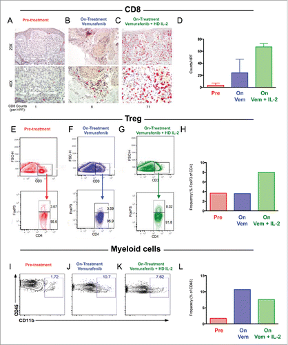 Figure 3. Increased CD8 T cells, Regulatory T cells, and Myeloid cells following combination vemurafenib and HD-IL-2. A-D) Immunohistochemical staining for CD8 T cells (red) at 20X and 40X magnification prior to therapy (A), on BRAF inhibitor prior to HD-IL-2 (B) and on combination BRAF inhibitor and HD-IL-2 (C) in two patients with quantification of CD8 per HPF (D). E-H) Flow cytometry showing percentage of Tregs at pre-treatment (E), on vemurafenib prior to HD-IL-2 administration (F), and on combination vemurafenib + HD-IL-2 (G) as well as quantification of Tregs (H). I-L) Flow cytometry showing percentage of CD11b myeloid cells at pre-treatment (I), on vemurafenib prior to HD-IL-2 administration (J), and on combination vemurafenib + HD-IL-2 (K) as well as quantification of CD11b myeloid cells (L).