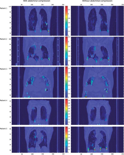 Figure 4. Ventilation maps for all patients both with and without abdominal compression in a frontal imaging plane showing the patients’ tumours. Horizontal axis shows lateral pixel value (the TPS converts the 512 × 512 pixels CT images to 256 × 256 pixels when performing a DIR), vertical axis shows CT slice number. Note that the colour scales, showing the value of the Jacobian determinant (Det(J), unitless), are synchronised for each patient, while it changes the upper limit between patients. The lower limit is set at Det(J) = 1 corresponding to no local volume change. The brightest areas of the ventilation maps thus have the highest ventilation.