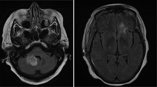 Figure 3. (left) Final magnetic resonance imaging (MRI) (12/30/19) showing decrease in the size of right cerebellar peduncle lesion after antibiotics. (right) Final MRI showing decrease in left frontal lobe lesion after antibiotics