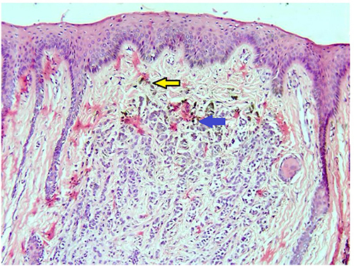Figure 4 H&E-stained section (100x) which shows the proliferation of nevus cells, with junctional separation and differentiation of lesional cells. Yellow arrow points to type A cells and blue arrow points to type B cells.