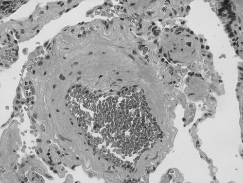 Figure 1 Histologic evidence of vascular changes in a small pulmonary artery in a patient with COPD and associated pulmonary hypertension. Hematoxylin and eosin staining demonstrates marked medial and intimal thickening with resulting luminal narrowing (40X, original magnification). Photomicrograph was provided courtesy of Hai Bui, MD, Department of Pathology, Cincinnati VAMC, Cincinnati Ohio.