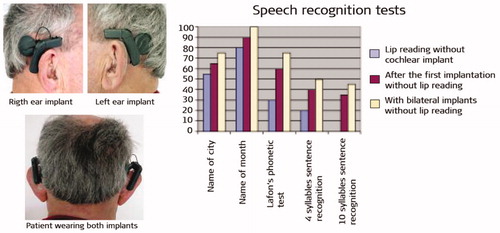 Figure 18. Patient wearing MED-EL CI device on both ears. Speech recognition test results showing better hearing in bilateral listening condition [Citation19].