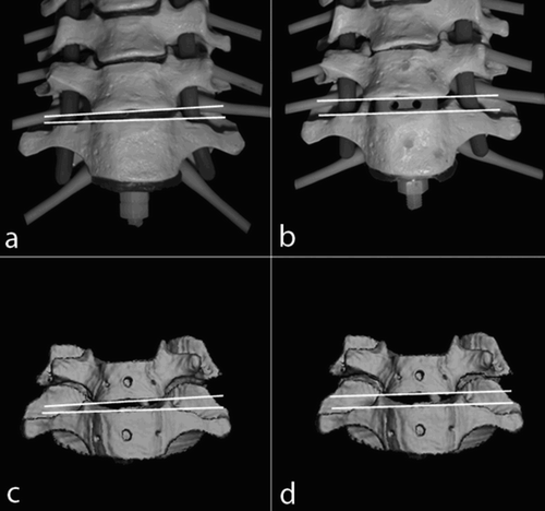 Figure 4. Computed 3D reconstruction before (c) and after (d) simulated cage-fusion C6/7 compared with a digital photograph of the pre- and post-interventional spine model (a and b).